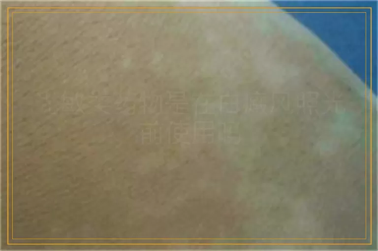 光敏类药物是在白癜风照光前使用吗