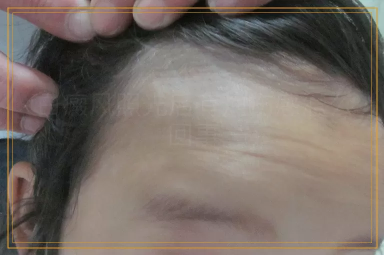 白癜风照光后有灼伤感怎么回事