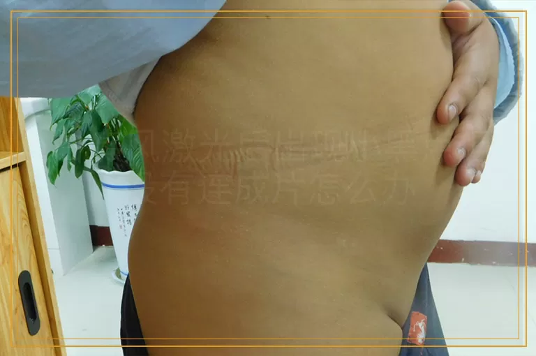 白癜风激光后出现小黑点但没有连成片怎么办