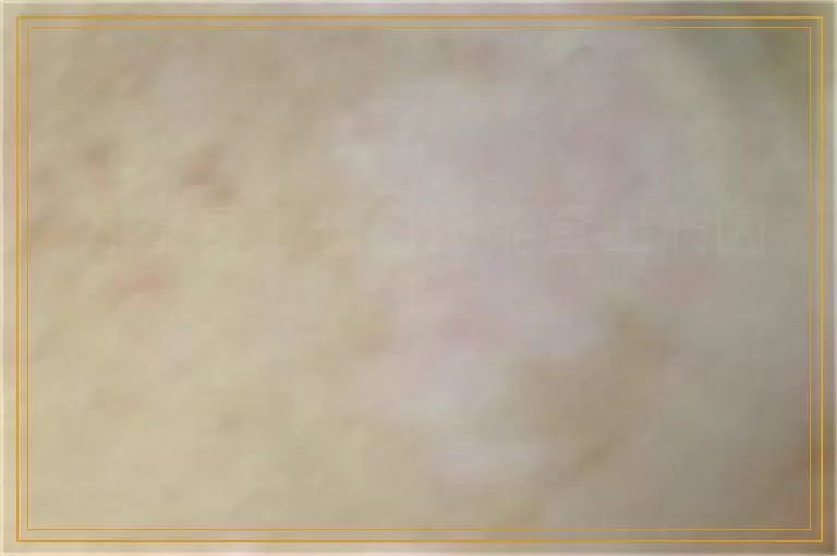 儿童身上长白斑能查出病因吗