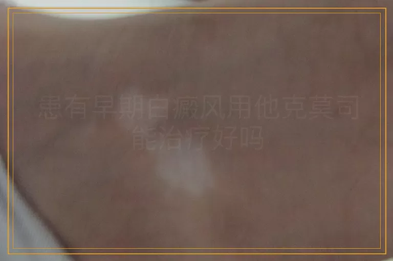 患有早期白癜风用他克莫司能治疗好吗