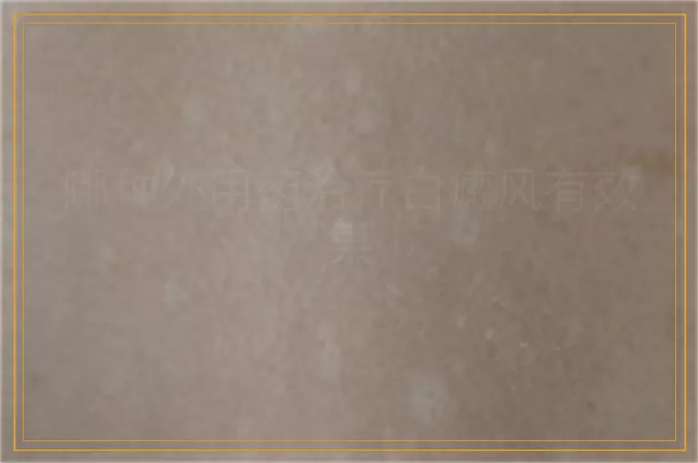 哪种外用药治疗白癜风有效果