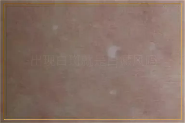 出现白斑就是白癜风吗