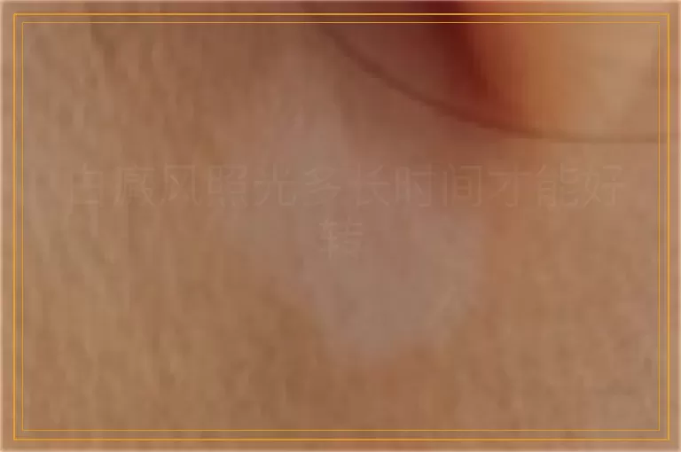 白癜风照光多长时间才能好转