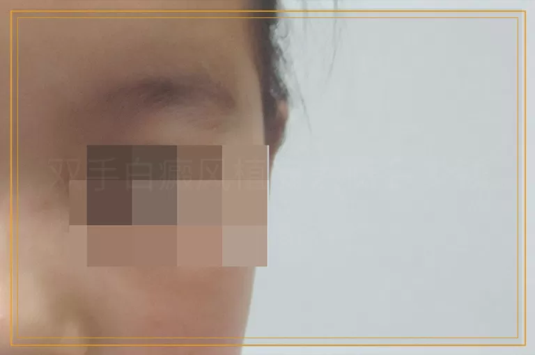 双手白癜风植皮大概多少钱