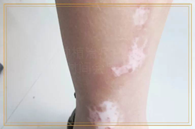 黑色素种植治疗白癜风多长时间会康复