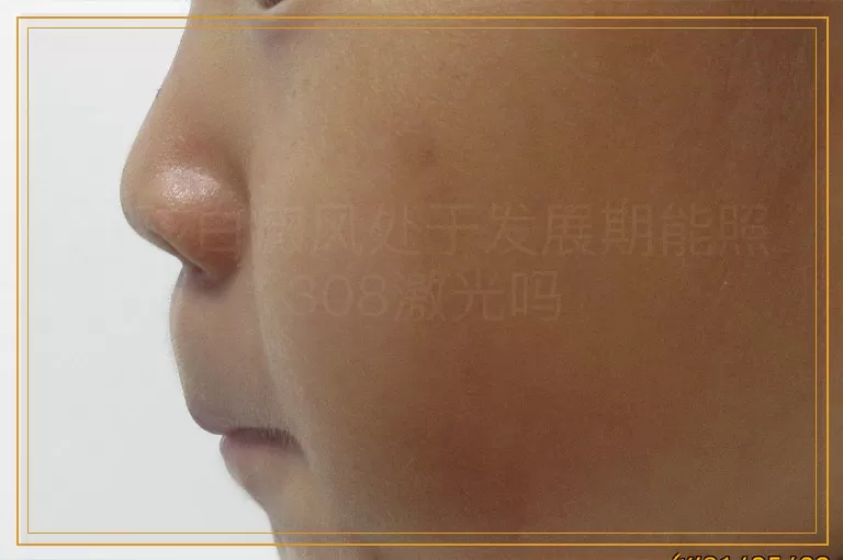 小孩白癜风处于发展期能照308激光吗