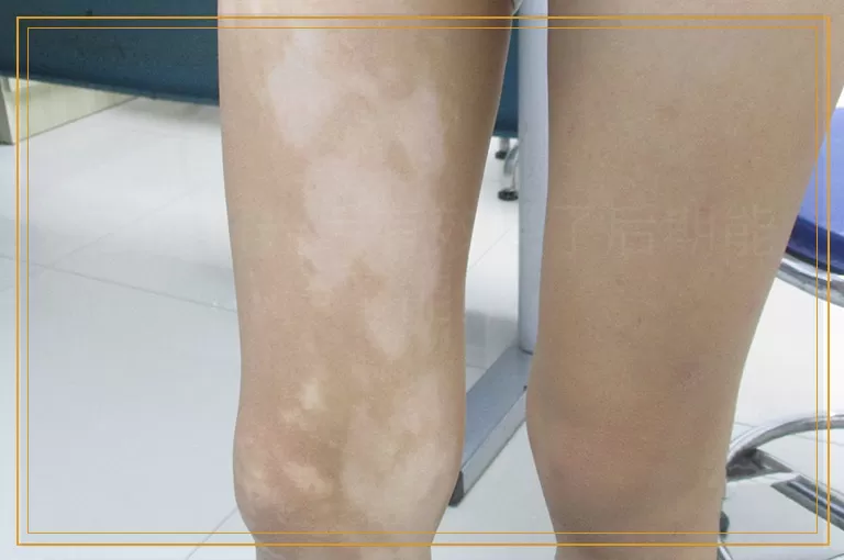 白斑照光后有效果了后期能不能停