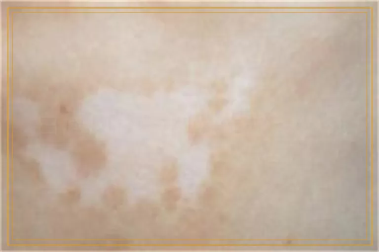 白癜风做一次激光是多少钱