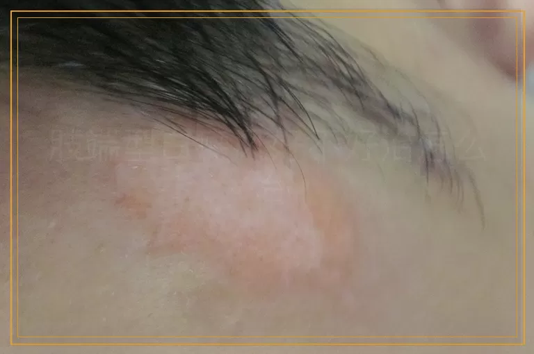 肢端型白癜风好不好治怎么治