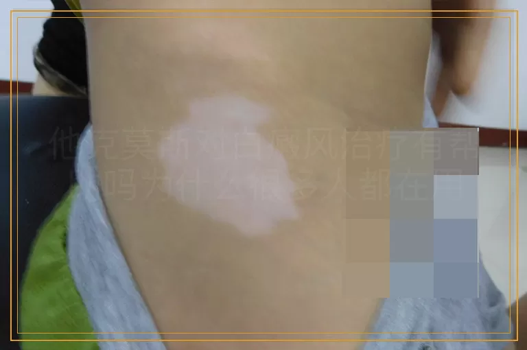 他克莫斯对白癜风治疗有帮助吗为什么很多人都在用