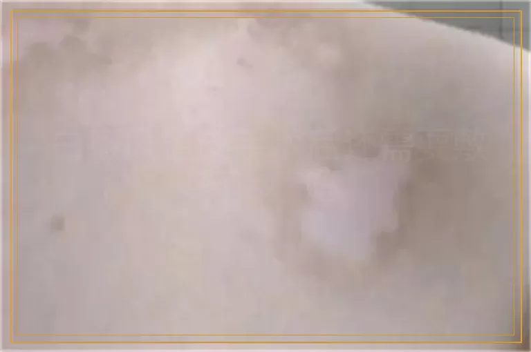白癜风植皮手术后还需要敷药治疗吗