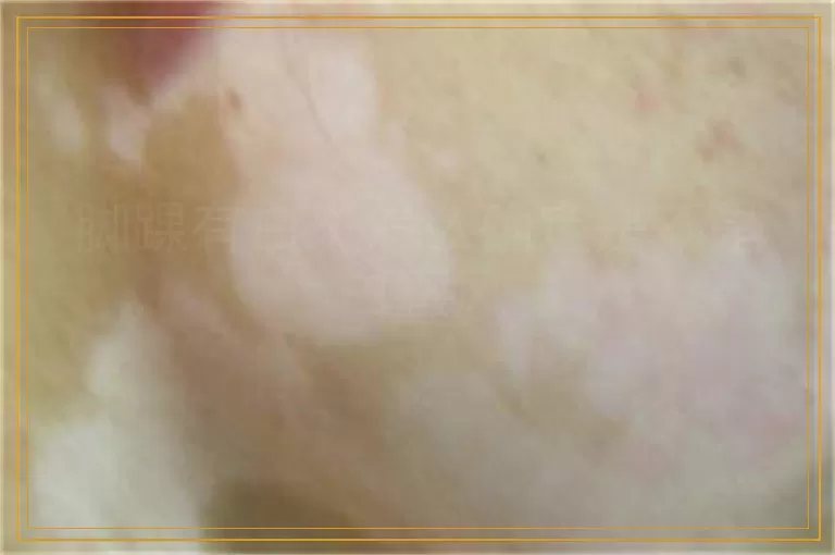 脚踝有白斑怎么确定是不是白癜风