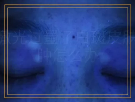 308激光过量了白斑皮肤有点肿怎么办