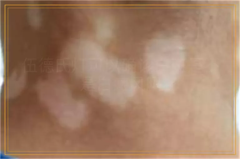 伍德氏灯可以确诊白斑是不是白癜风吗