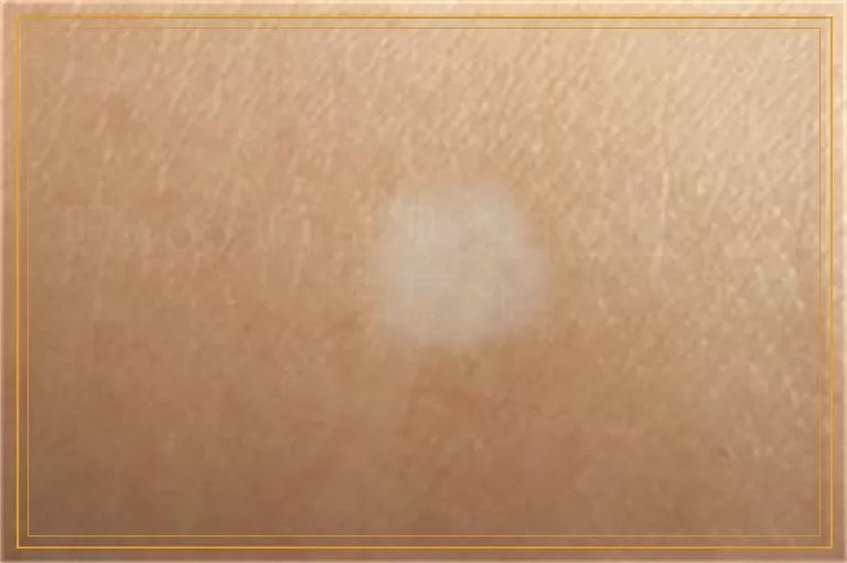 照wood灯呈现淡白色是不是白癜风