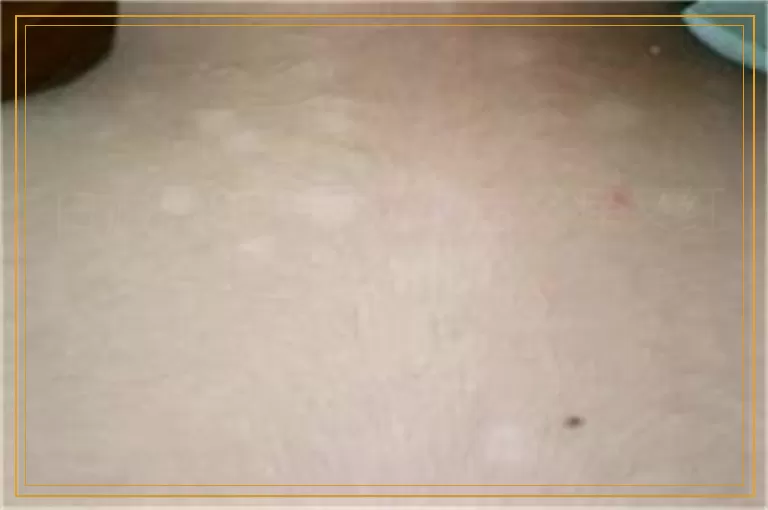 白癜风308照光之后又痒又红怎么办