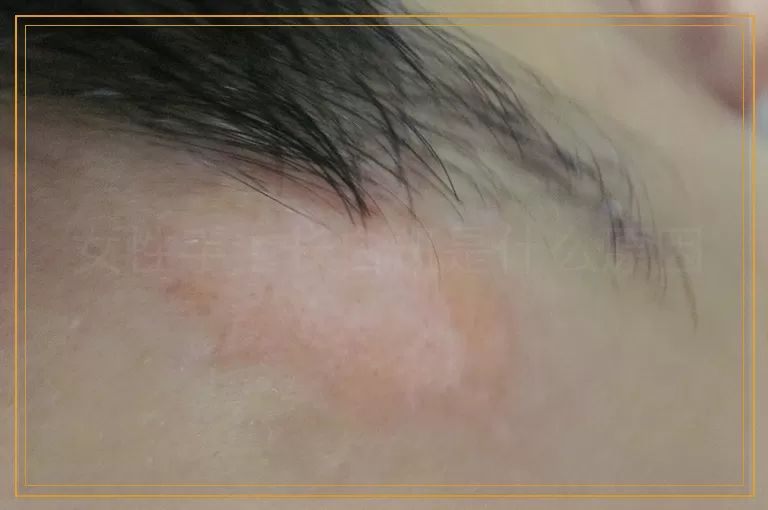 女性手上长白斑是什么原因