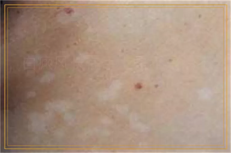 白癜风长在手上是不是治不好