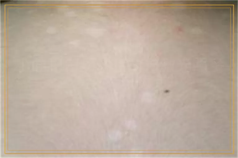 小面积白癜风用308激光照多少次可以恢复