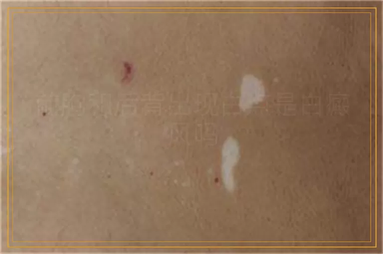 前胸和后背出现白点是白癜风吗