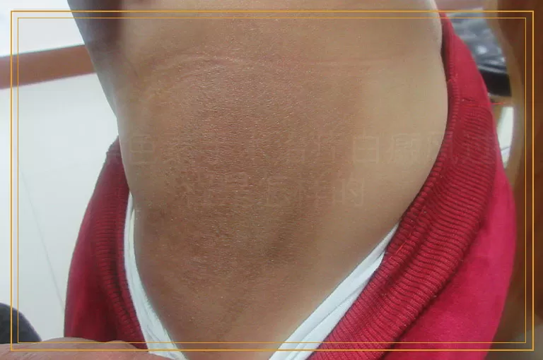 做黑色素手术治疗白癜风过程是怎样的