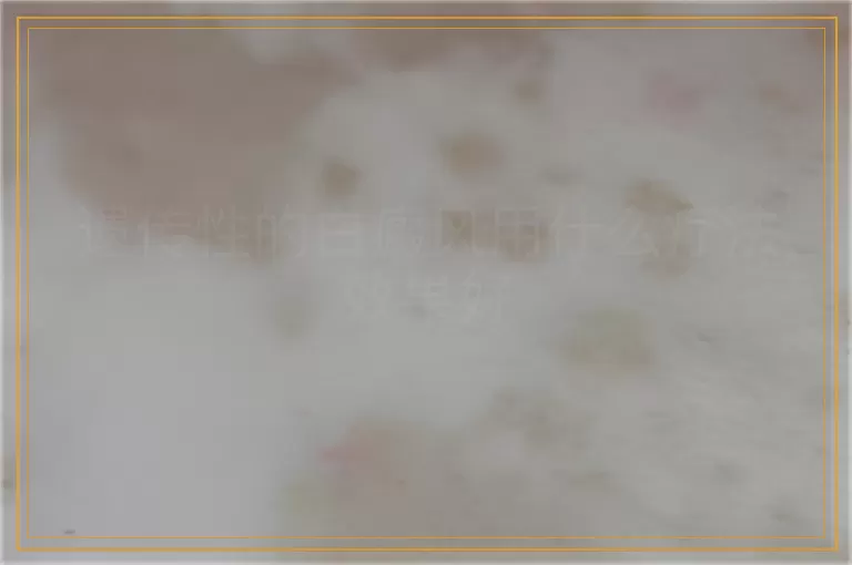 遗传性的白癜风用什么疗法效果好