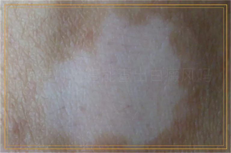 伍德灯检查能查出白癜风吗