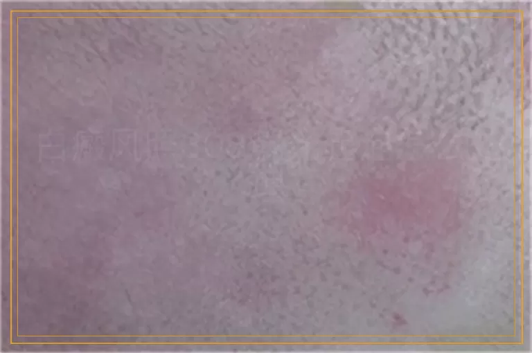 白癜风照308激光起泡怎么处理