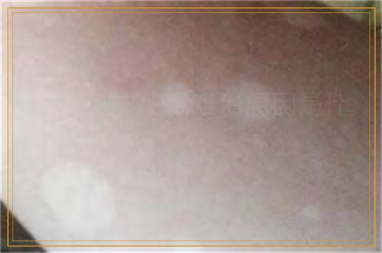 肢端型白癜风难治原因是什么