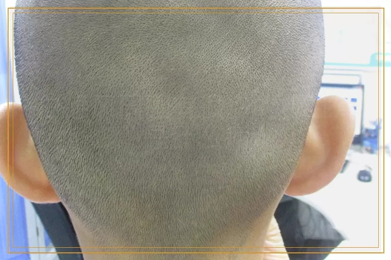 白癜风周围有很多的小红点是什么病