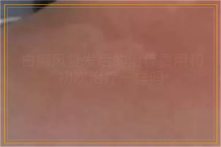 白癜风复发后的治疗费用和初次治疗一样吗