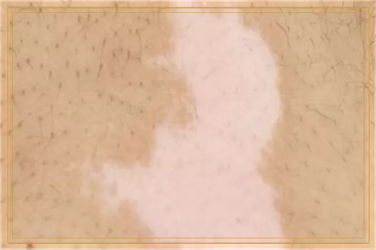 治白癜风德国308好还是美国的好