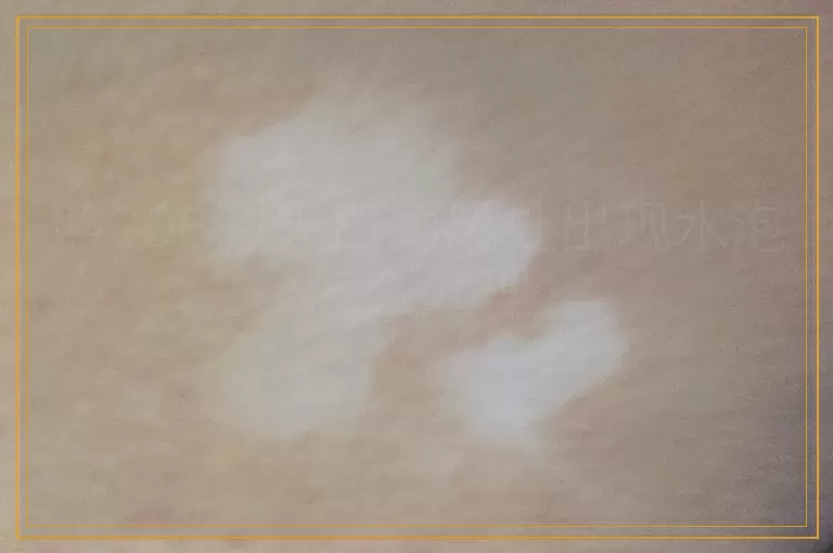 照308激光白癜风处出现水泡怎么处理