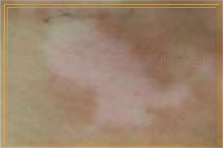 白癜风是不是每天都照一回好的快