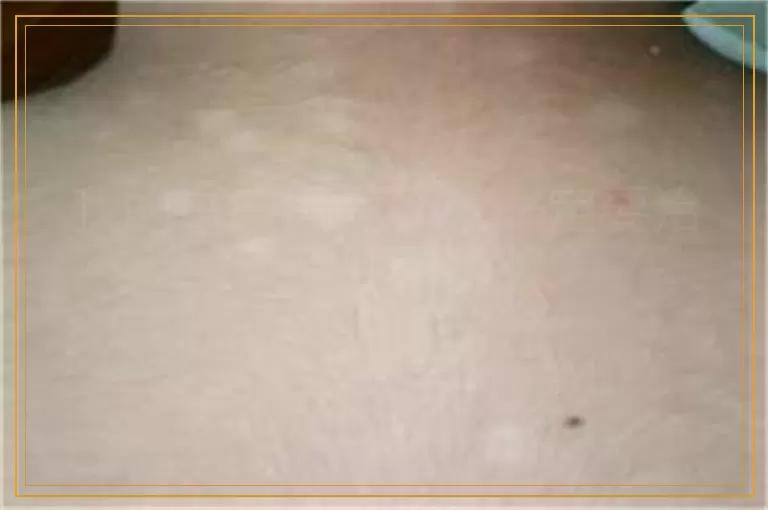 我的白癜风为什么一定要治疗