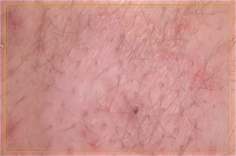 小孩肢端型白癜风能不能治好