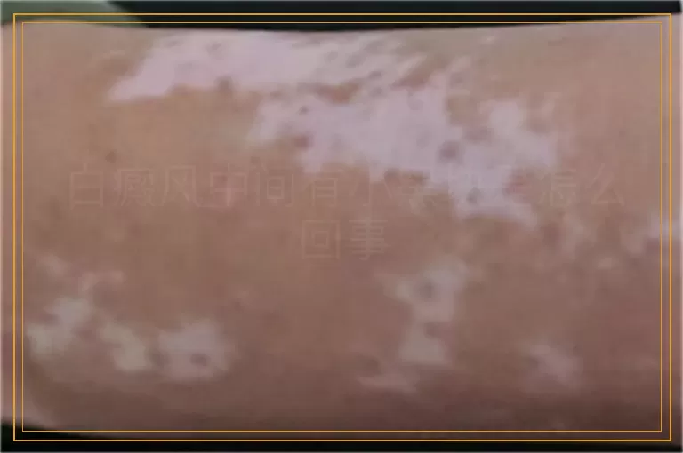 白癜风中间有小黑块是怎么回事
