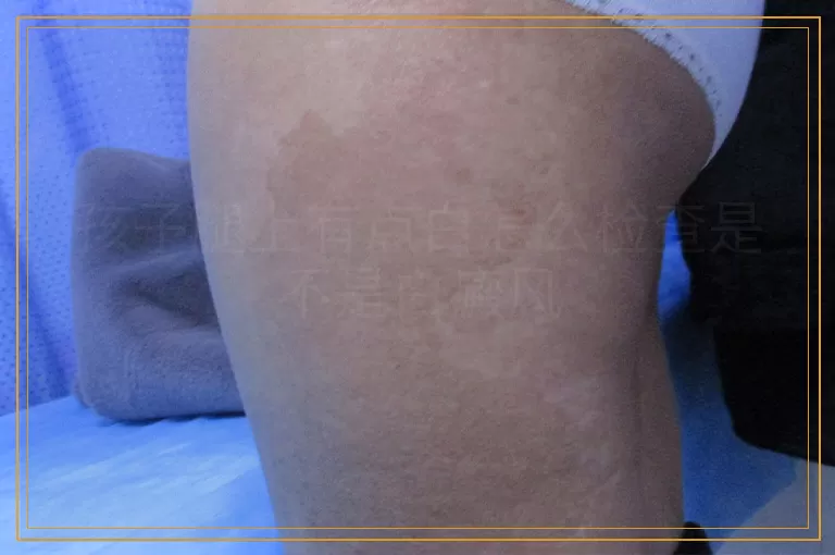 孩子腿上有点白怎么检查是不是白癜风