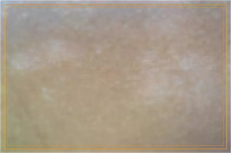 白癜风照308激光后出现色素岛多久能好