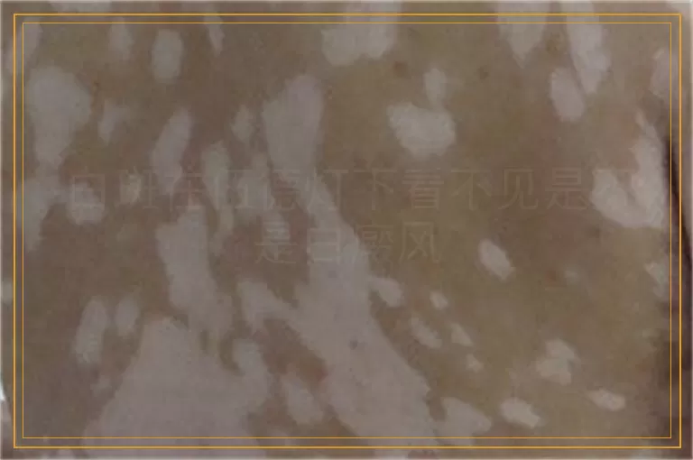 白斑在伍德灯下看不见是不是白癜风