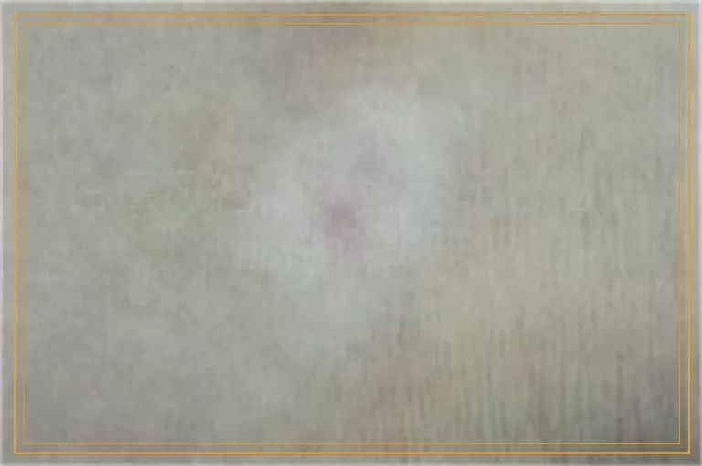 白癜风初期颜色不明显伍德灯能确诊出来吗