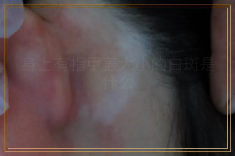身上有指甲盖大小的白斑是什么