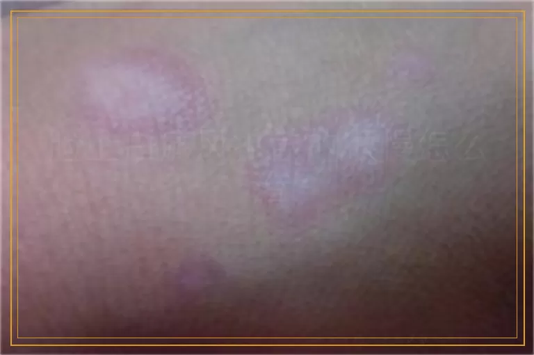 脸上白癜风扩散的很慢怎么治