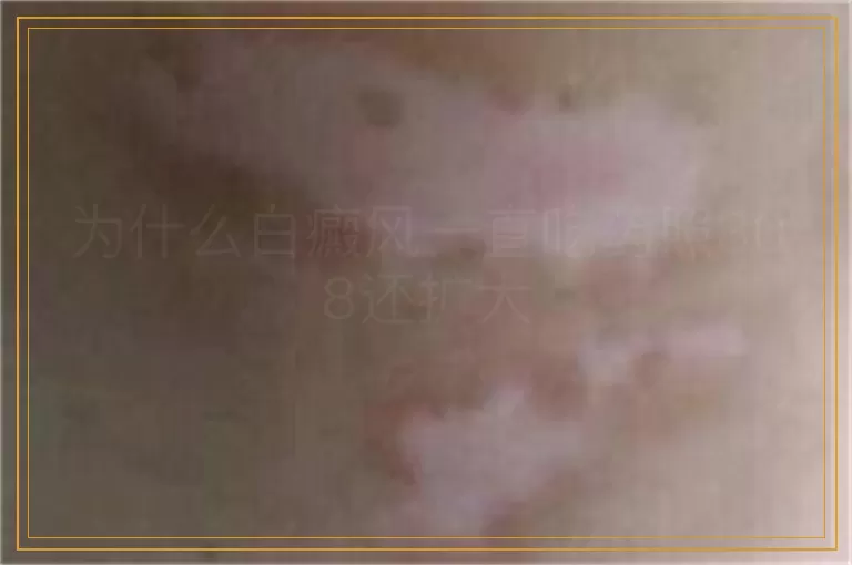 为什么白癜风一直吃药照308还扩大