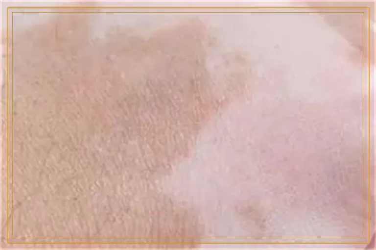 臀部白一块像白癜风做什么检查