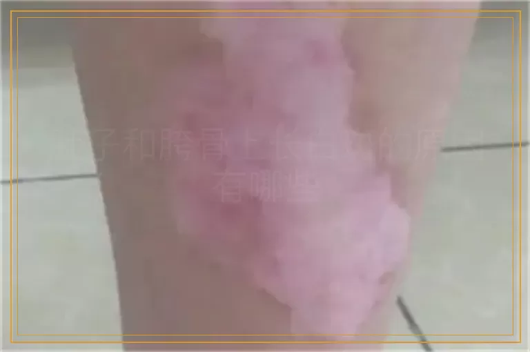 肚子和胯骨上长白斑的原因有哪些