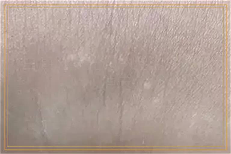 白癜风照光起的泡泡多久能消失