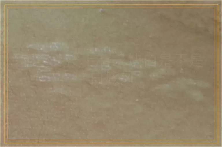 宝宝头皮上有一块白是不是白癜风