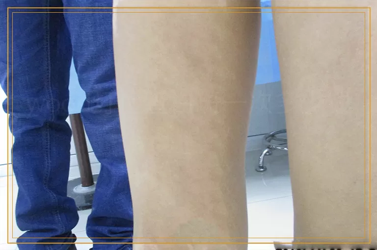 wood灯检查白斑一次多少钱